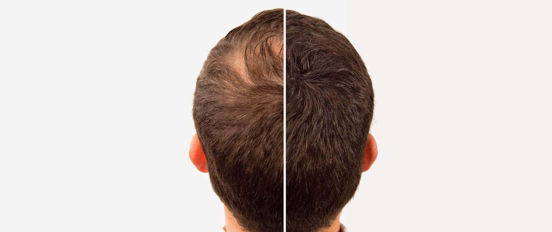 Hair transplantation clinic in hyderabad