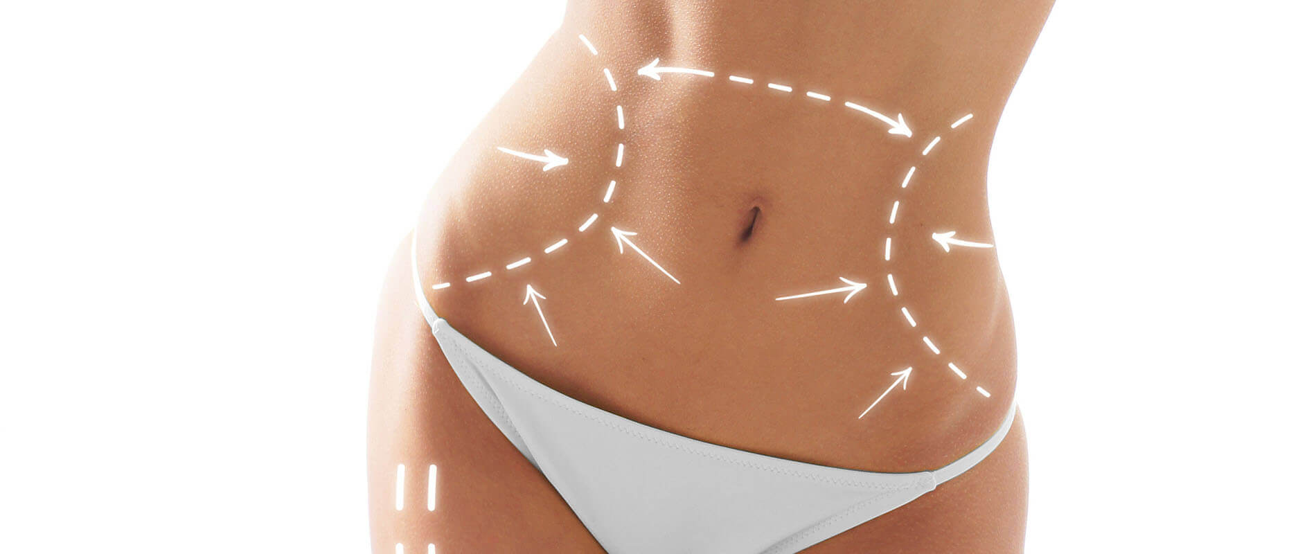 tummy tuck surgery clinic in hyderabad